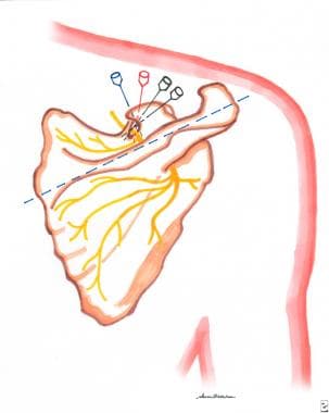 Suprascapular nerve block technique. See text for 