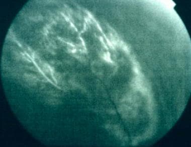 Early fluorescein angiogram of choroidal melanoma 