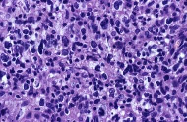 Another example of a diffuse large cell lymphoma. 