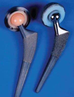 Prosthetic hip implants with ceramic-on-ceramic al