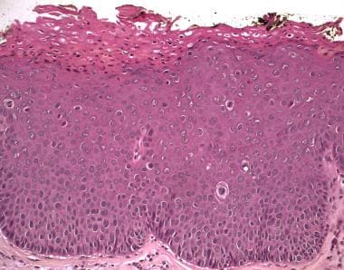 Severe dysplasia. The atypical features seen here 