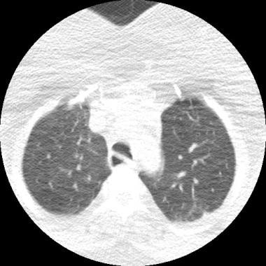 Dynamic CT scan of chest during expiration in norm
