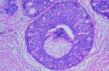 Histopathological image of mixed mucinous breast cancer (MMBC) with