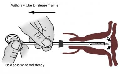 Releasing the arms of the copper T380A IUD. 