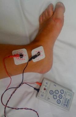 Peripheral Nerve Stimulator - Train of Four Monitoring: Overview ...