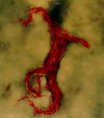 Acid-fast bacillus smear showing characteristic co