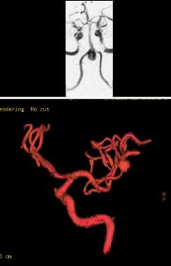 MR angiography demonstrates unruptured aneurysm at