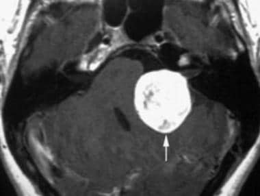 Contrast-enhanced T1-weighted magnetic resonance i