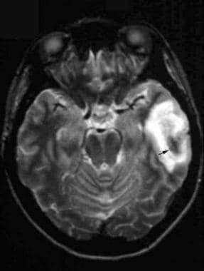 Axial T2-weighted image reveals left temporal lobe