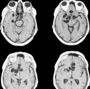 MRIs of the brain show multiple, large, cysticercu