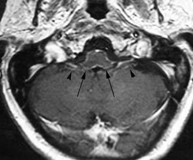 Axial T1-weighted image postcontrast at the level 