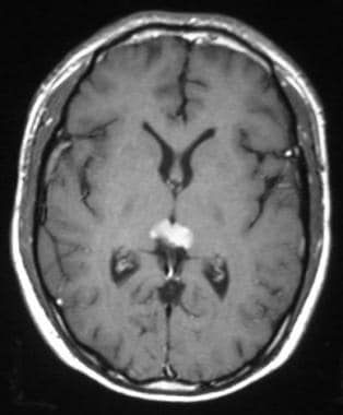 Pineal germinoma in a 19-year-old man. Axial T1-we