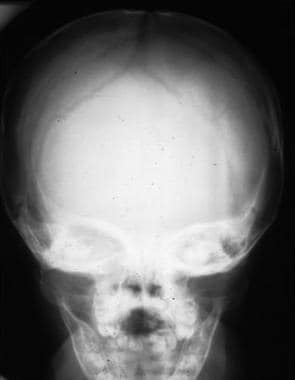 Frontal skull radiograph of a child shows the usua