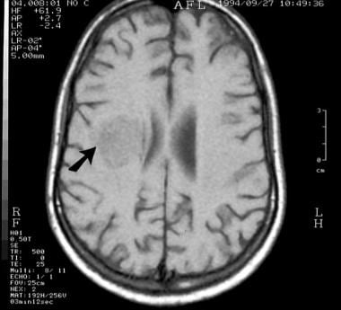 T1-weighted axial brain magnetic resonance image a