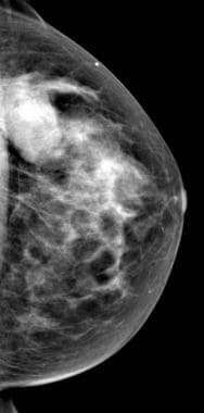 Breast Fibroadenoma Imaging: Practice Essentials, Radiography, Magnetic  Resonance Imaging