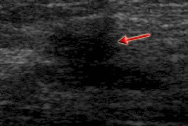 Ultrasonogram demonstrates acoustic shadowing and 