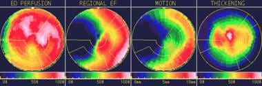 Polar maps can help identify abnormal findings on 