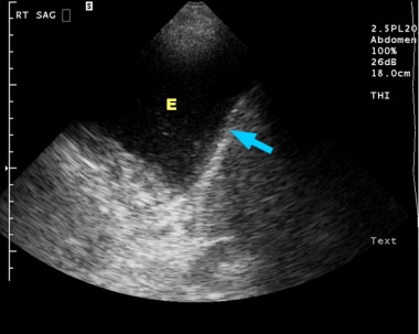 Ultrasonogram of the right lower chest in a 60-yea