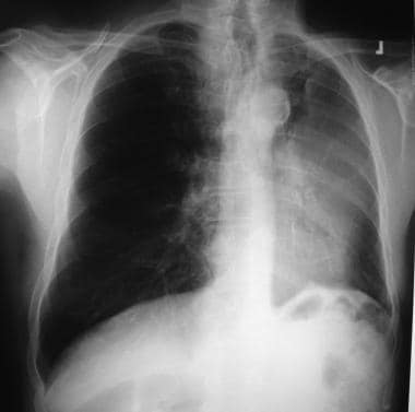Non–small cell lung cancer. Left upper collapse is