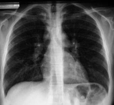 Posteroanterior (PA) chest radiograph in a 16-year