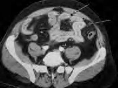 A 47-year-old man with blunt trauma to the abdomen