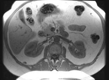 Cholelithiasis. Multiple tiny gallstones appear as