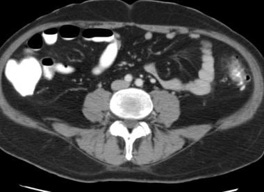 CT scan demonstrates mild diverticulitis of the de