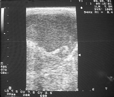 Intraoperative sonogram demonstrates internal echo