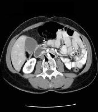 Lower-level arterial-phase, contrast-enhanced CT s