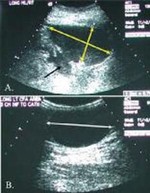 Following a renal transplant, decreased renal func