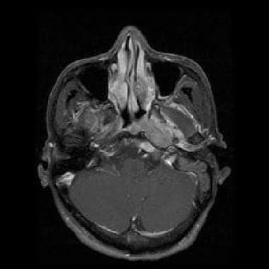Gadolinium-enhanced axial T1-weighted MRI shows na