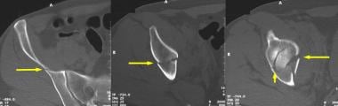 Anterior column fracture with a posterior hemitran
