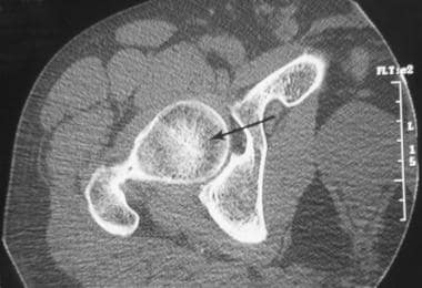 Axial computed tomography scan in a patient withou