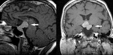 Sagittal (left image) and coronal (right image) T1