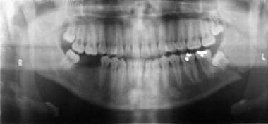 Panoramic radiographic image shows a left angle fr
