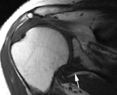 Oblique coronal T1-weighted image demonstrates a h