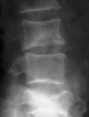 Severe Osteoporosis X Ray