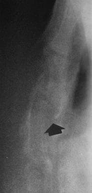 Lateral radiograph shows a complete displaced frac