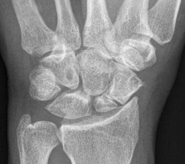 Scaphoid Fracture Imaging: Overview, Radiography, Computed Tomography