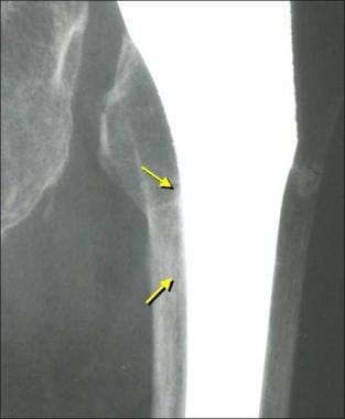 Image from a patient who had a normal total hip ar