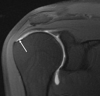 supraspinatus tear mri