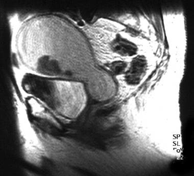 An 83-year-old woman with moderately differentiate