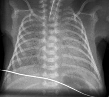 infant pneumothorax x ray