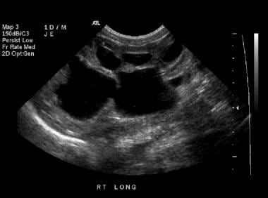 Longitudinal sonogram of the right kidney (same pa