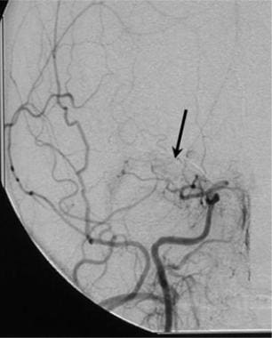 Anteroposterior intracranial carotid angiogram sho