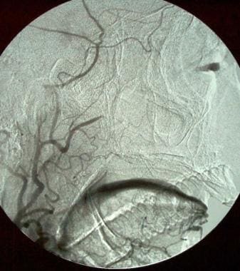 Postembolization digital-subtraction angiogram in 