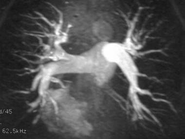Pulmonary angiography. Maximum intensity projectio
