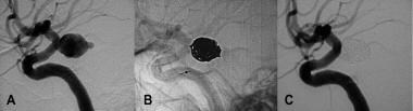 Large ruptured aneurysm before embolization (A) an