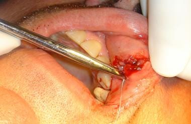 Intraoral approach to close the deep layer. 