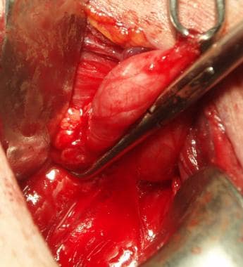 Zenker diverticulum repair 2025 with cervical stenosis